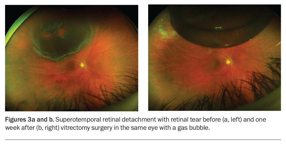 retinal-detachment-causes-symptoms-and-treatment-options-mama